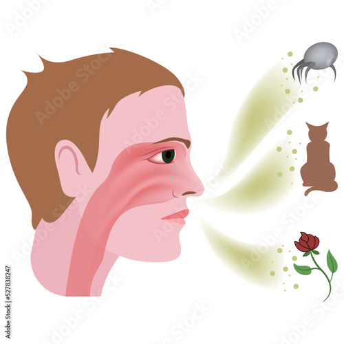 allergic rhinitis. Disease, with swelling and inflammation of the nasal mucosa. Reaction to grass or tree pollen, house dust mites. Vector illustration.