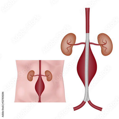 Shunting of an aneurysm of the abdominal aorta. Medical poster, vector illustration