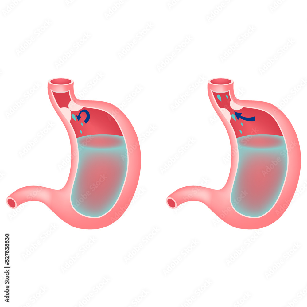Gastroesophageal reflux disease. Chronic pathology that occurs due to