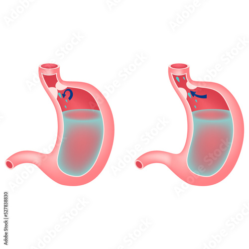 Gastroesophageal reflux disease. Chronic pathology that occurs due to weak work of the muscular valve of the esophagus. I will throw the contents of the stomach back into the esophagus. Medical poster