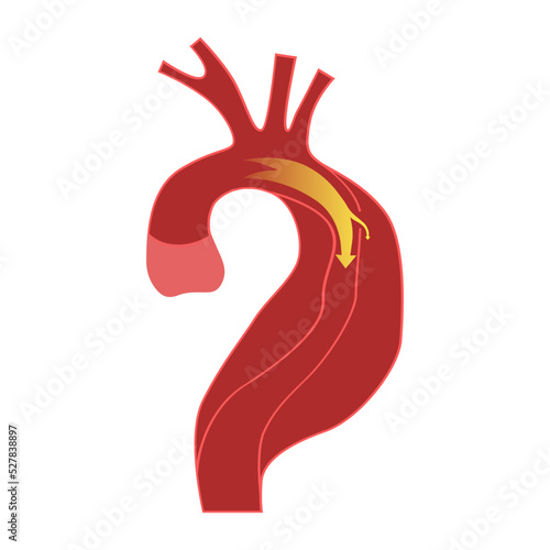 Aortic dissection, dissecting aneurysm. Disease infographic. Medical poster. Vector illustration