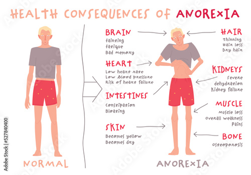 Eating disorder in men and boys. Anorexia nervosa. photo
