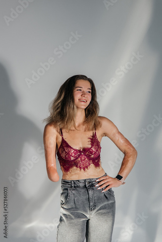 Smiling young woman with amputee arm and scars from burn on her body poses in lacy bra. photo