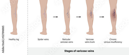 Stage of varicose veins. Varicose veins in the human leg vector. photo