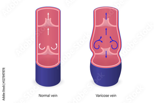 Varicose vein vector. The difference of normal vein and varicose vein.