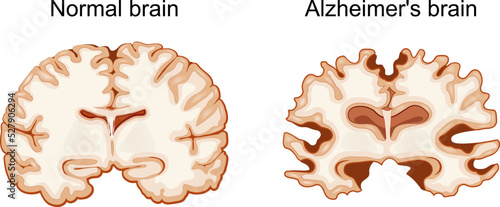 Normal brain and Alzheimer's brain