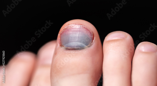 Close-up bruised nail of the big toe. Violet toenail. Injured foot.