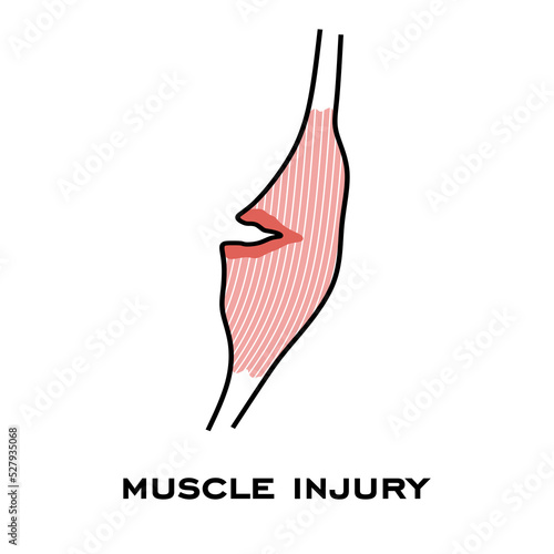 Muscle injury icon. Muscle pain sign. Pulled Hamstring Isolated on white background. Hamstring Strain symbol. pulled a muscle vector illustration