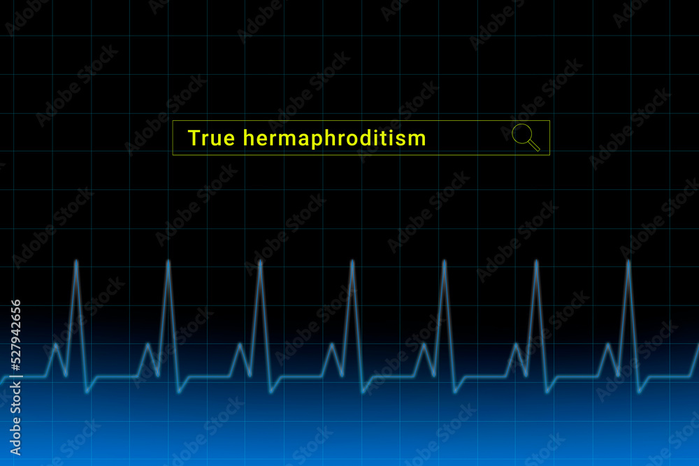 True hermaphroditism.True hermaphroditism inscription in search bar