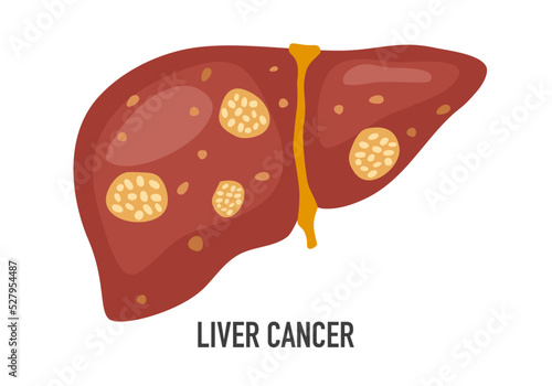 Liver cancer disease concept vector illustration on white background.
