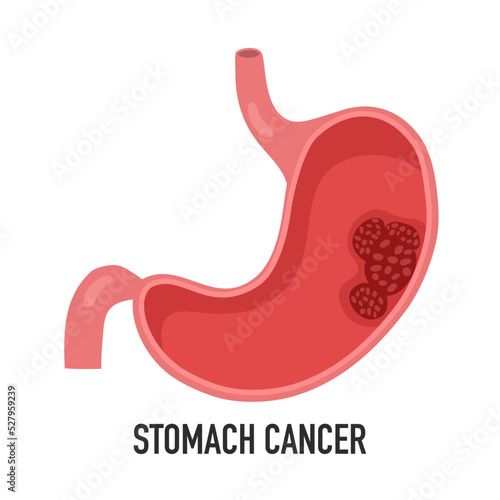 Stomach cancer disease concept vector illustration on white background.