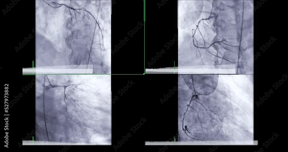 Coronary angiogram of coronary artery during cardiac catheterization in