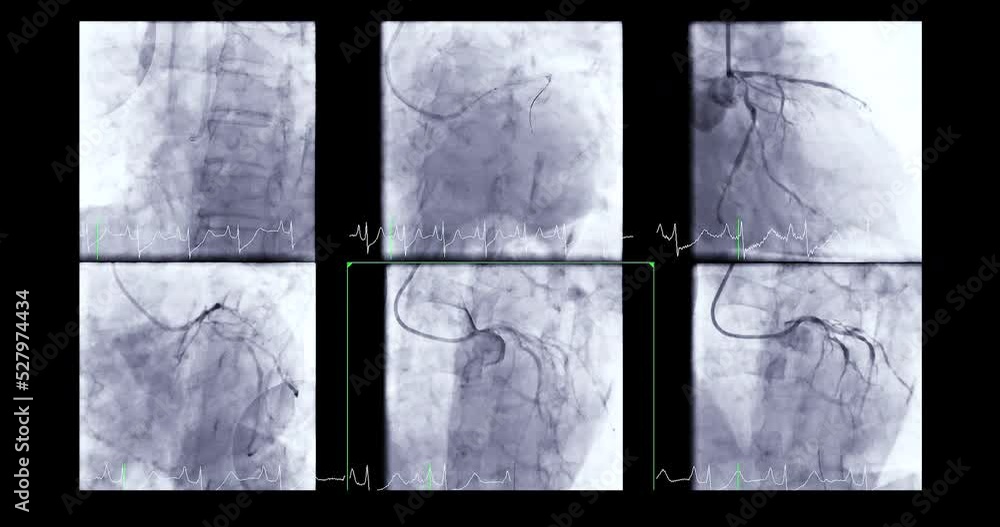 Coronary angiogram of coronary artery during cardiac catheterization in