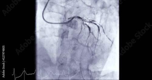 Coronary angiogram of coronary artery during cardiac catheterization  in cardiac catheterization laboratory. photo