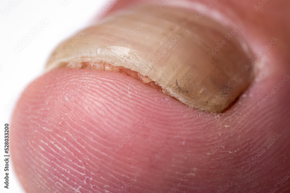 Fototapeta premium Close up image of a finger with nail fungus infection