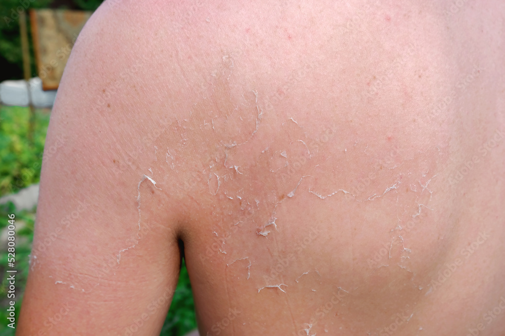 Fototapeta premium The man received sunburn on the seashore. The skin peels off. Protection of the skin from the sun.