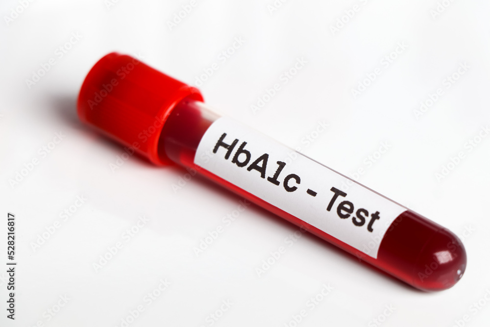 HbA1c test from blood , Blood samples to be analyzed in the laboratory