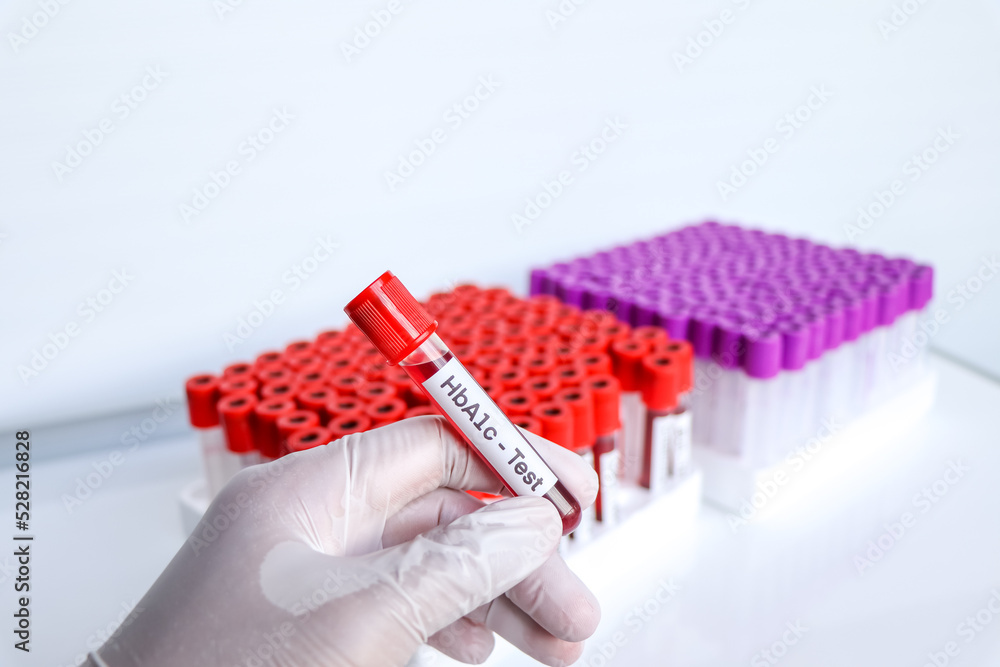 Foto de HbA1c test from blood , Blood samples to be analyzed in the