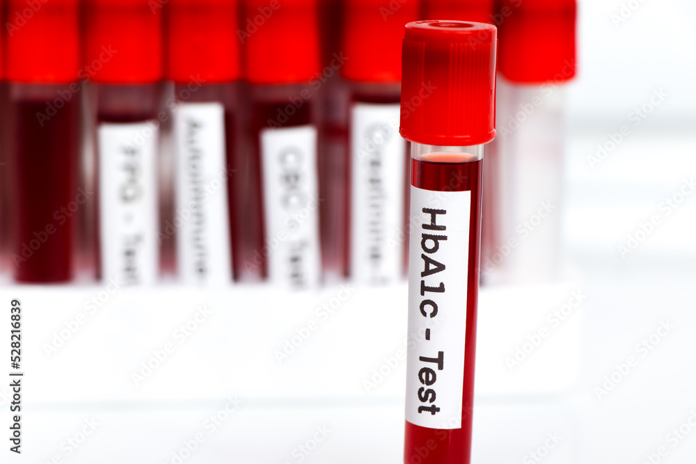 HbA1c test from blood , Blood samples to be analyzed in the laboratory