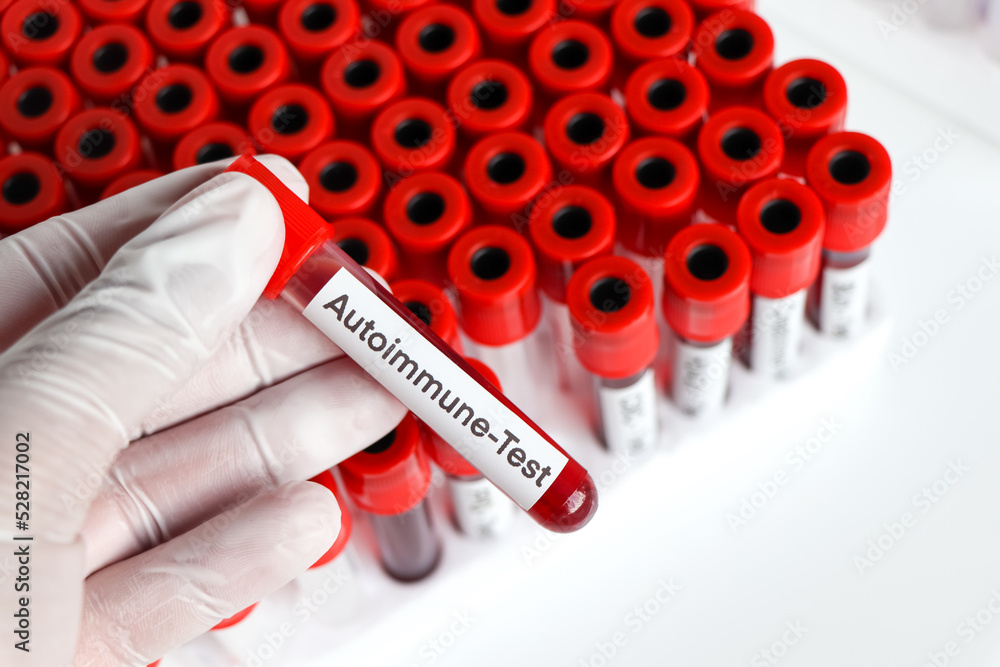 Obraz premium Autoimmune test from blood , Blood samples to be analyzed in the laboratory
