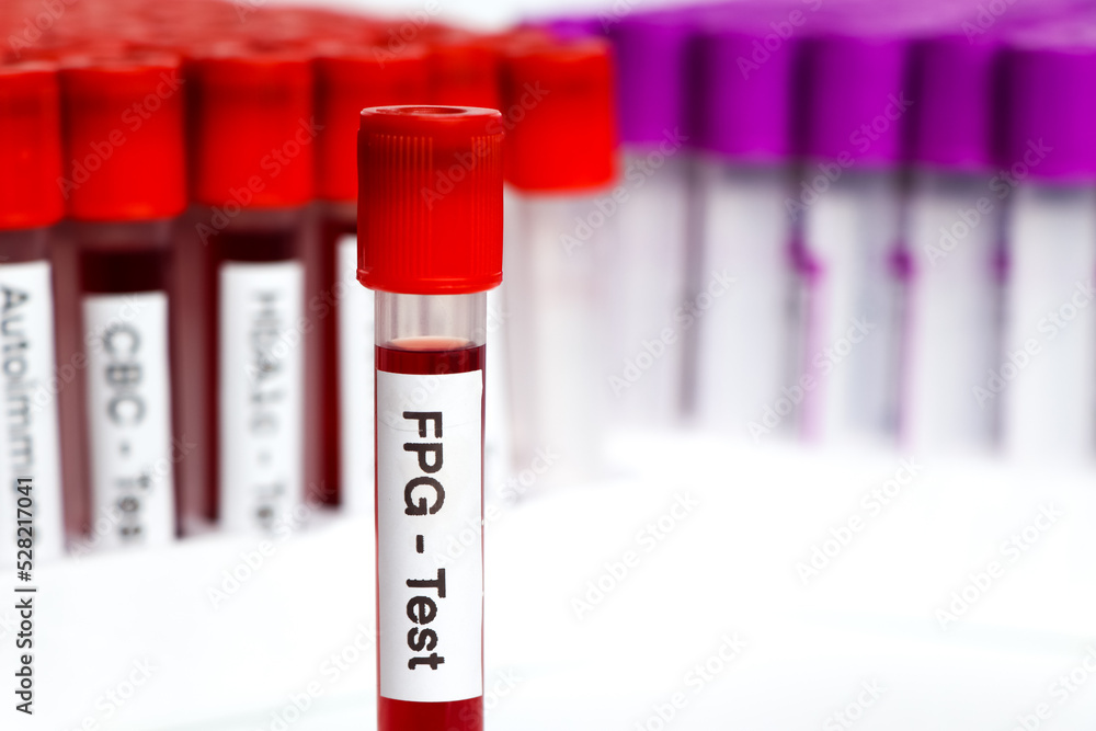 FPGtest from blood , Blood samples to be analyzed in the laboratory