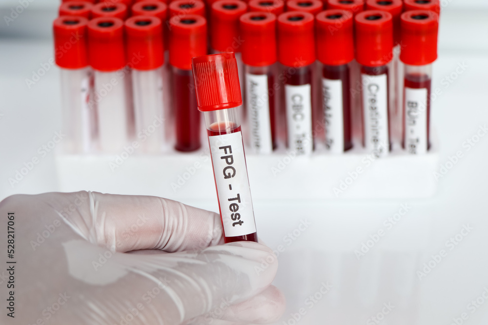FPGtest from blood , Blood samples to be analyzed in the laboratory