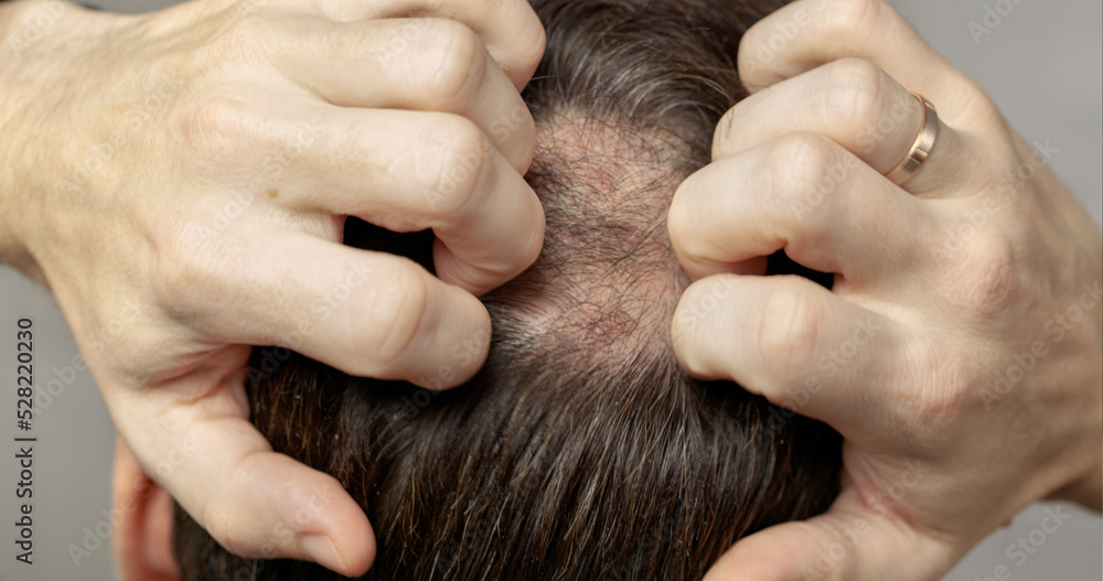 Man with hair loss problems closeup, isolated. Alopecia balding hairs on  man scalp. Human alopecia or hair loss - person hand pointing his bald  head. Scratching his head. Baldness. Depression, stress Stock