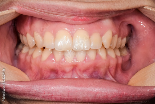 Front view of dental arches in occlusion, lips and cheeks retracted with four wooden tongue depressors. Healthy teeth and gingiva gum. 