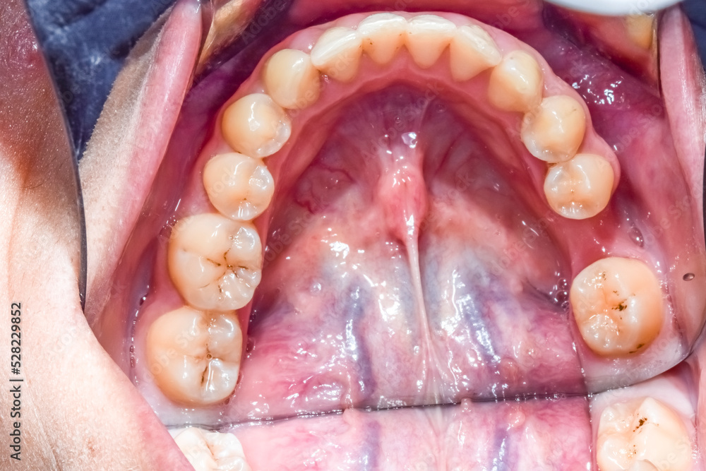 Occlusal view of a young woman mandibular arch with tongue retracted
