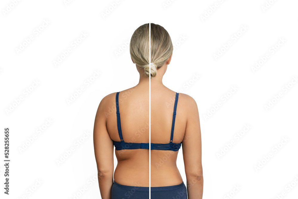 Young woman with excess fat on her back and arms and toned back