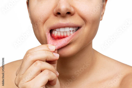 Gum inflammation. Cropped shot of a young woman shows red bleeding gums pulling the lip isolated on a white background. Close up. Dentistry, dental care photo