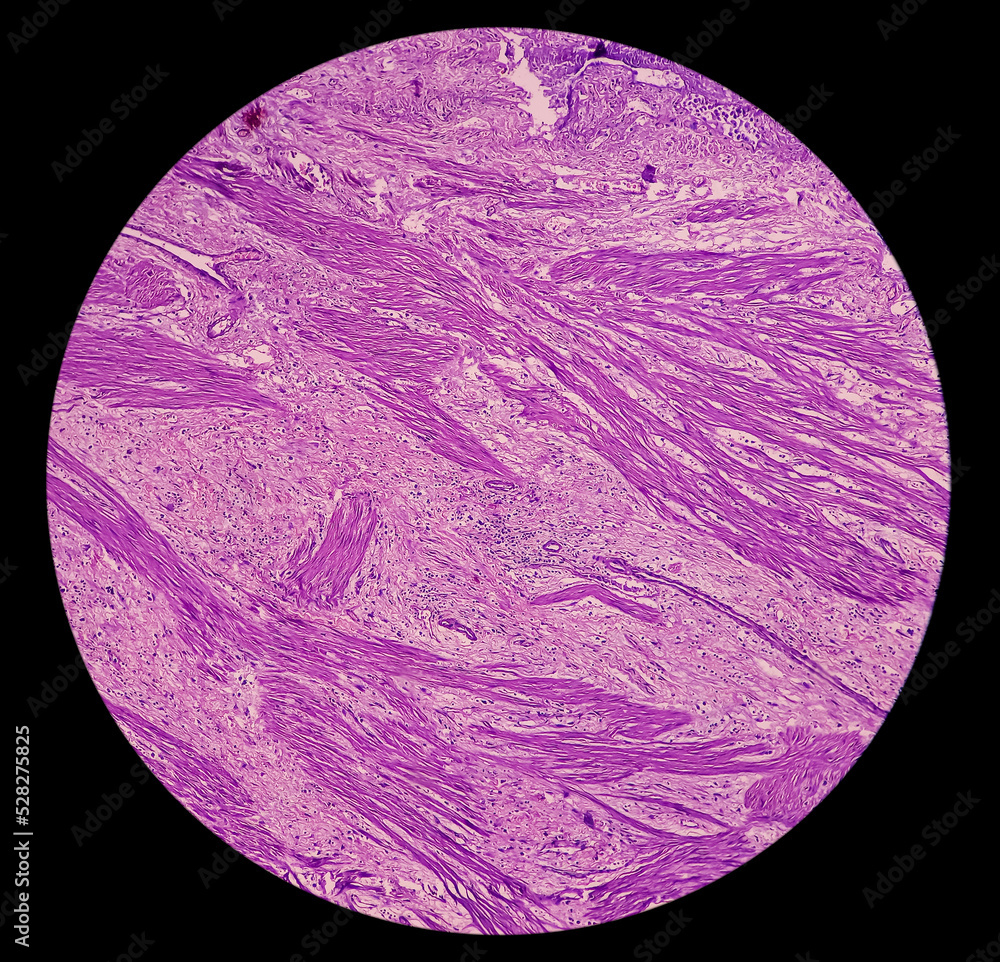 Suppurative cholecystitis of Gallbladder, show perimuscular fibrosis ...