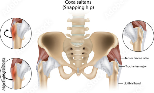 Coxa Saltans or Snapping Hip Snapping Hip Syndrome also referred to as dancer hip. Trochanter major, Tensor fasciae latae and Liotibial band photo