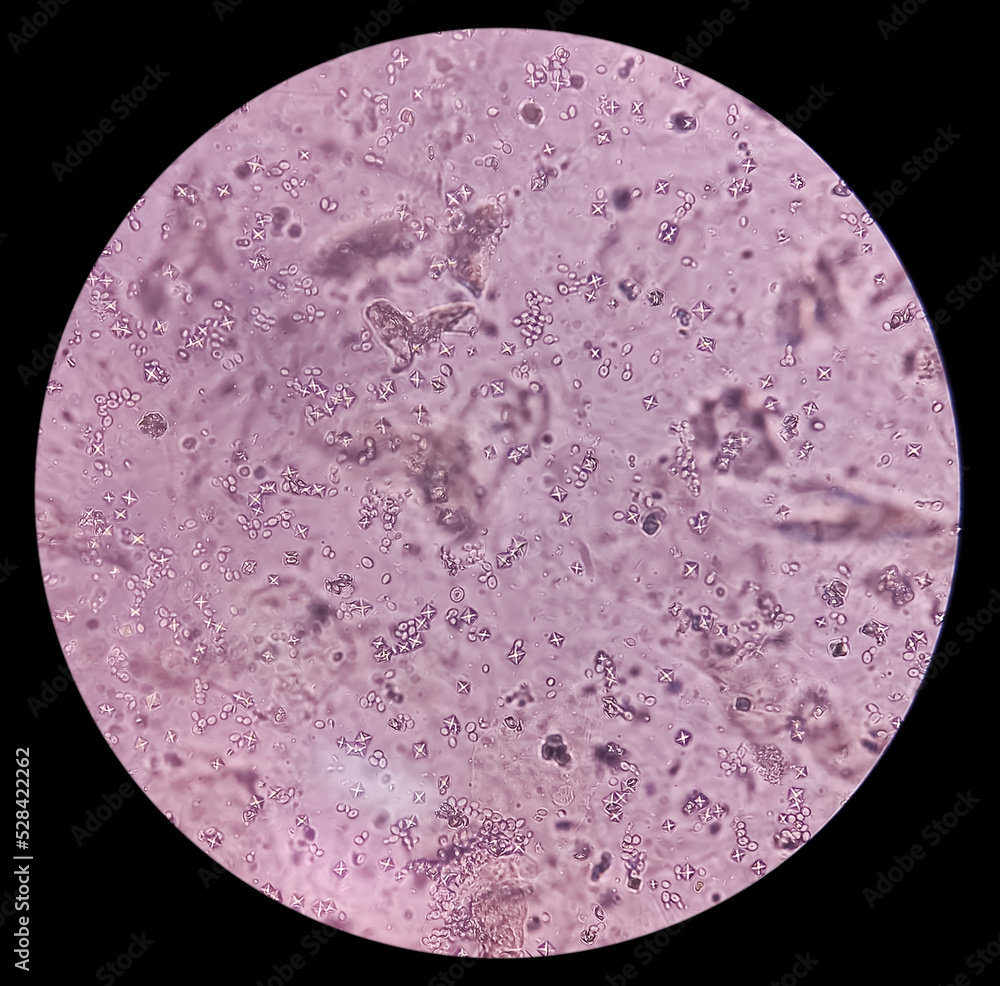 Budding yeast cells and calcium oxalate crystal in urine, urinary tract ...