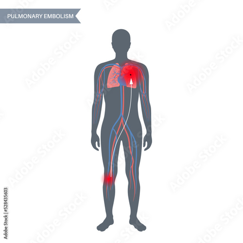 Pulmonary embolism disease