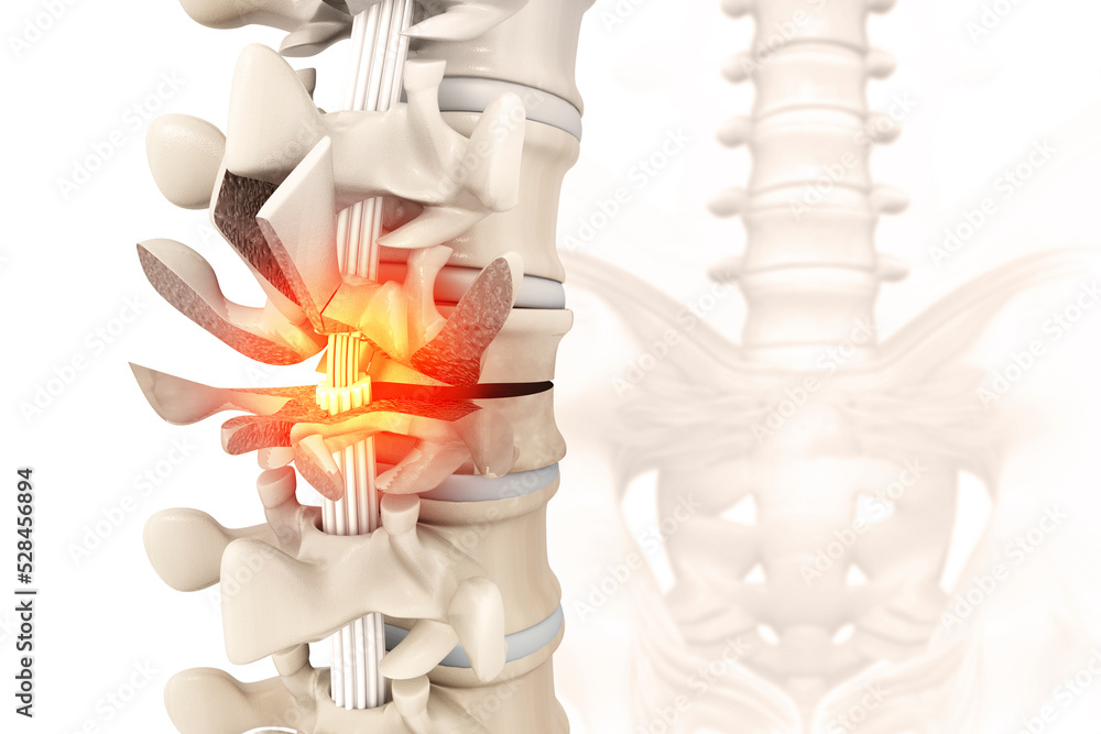 Spinal Fracture and traumatic vertebral injury. 3d illustration - obrazy, fototapety, plakaty 