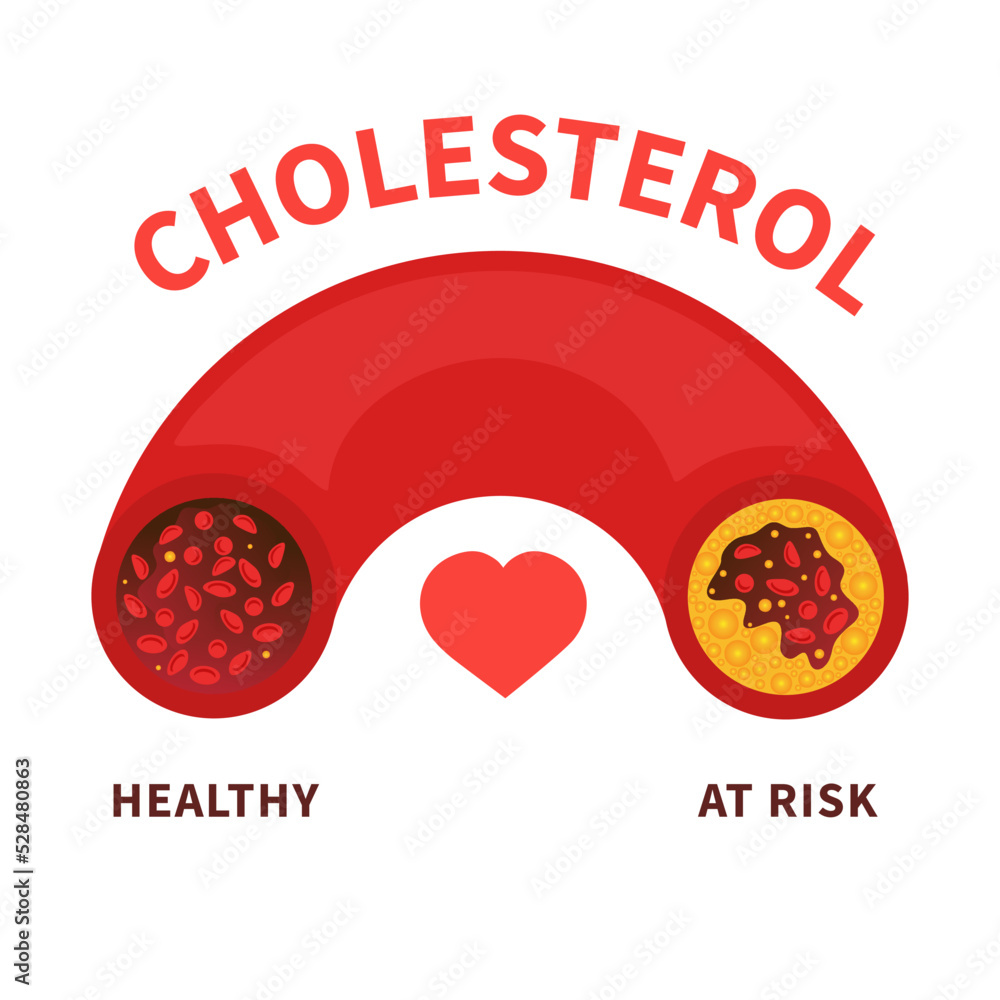 Cholesterol level on blood vessel medical diagram. Meter gauge of ldl