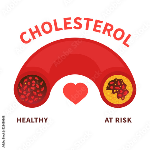 Cholesterol level on blood vessel medical diagram. Meter gauge of ldl and hdl lipoprotein. High and low fat test indicator. Coronary heart disease risk. Healthcare concept. Vector illustration.
