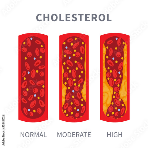 Healthy and narrowed blood vessel with cholesterol plaque buildup. Artery blocked with a fat cells clot. ldl and hdl lipoprotein comparison. Cross section medical diagram. Vector illustration.