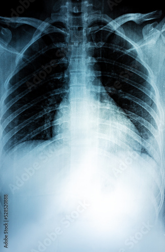 Film X-ray