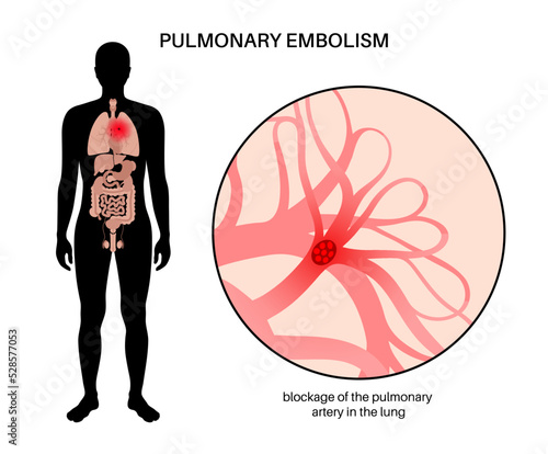 Pulmonary embolism disease