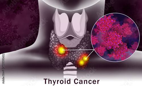 Illustration of human thyroid cancer on color background photo