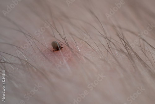 Sucking a tick Macro photo on human skin. Ixodes ricinus. The swollen parasite has bitten the irritated pink epidermis. Small red drops. Dangerous insect mite. Encephalitis, Lyme disease infection