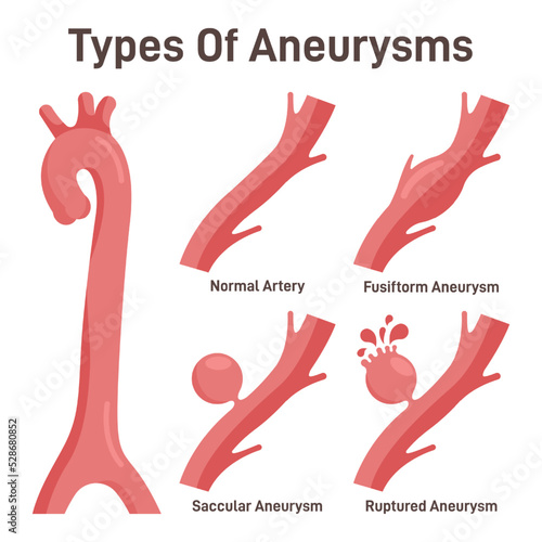 Thoracoabdominal aortic aneurysms types. Healthy aorta and aorta