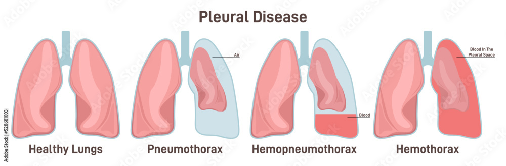 Pleural effusions. Abnormal gathering of blood or air in pleural space.