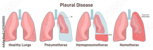 Pleural effusions. Abnormal gathering of blood or air in pleural space. photo