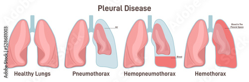 Pleural effusions. Abnormal gathering of blood or air in pleural space.