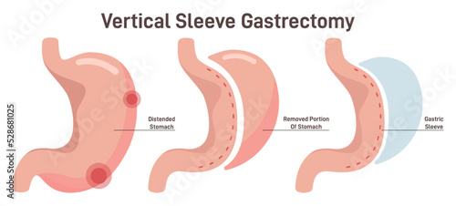Vertical sleeve gastrectomy. Distended stomach surgery, gastroenterology