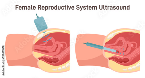 Ultrasound scanning. Female reproductive system research. Gynecological disease