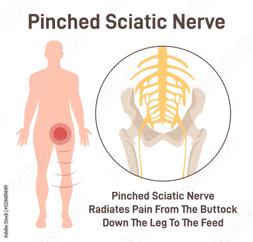 Sciatica. Pinched sciatic nerve causing pain and inflammation in pelvis photo